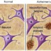 Amyloid Plaque
